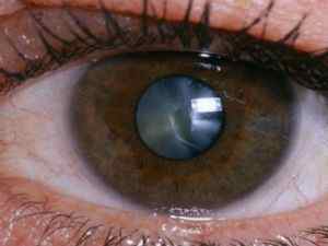 Незріла катаракта: лікування вікової (старечої) патології, причини, симптоми