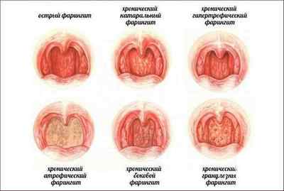 Інфекції дихальних шляхів: симптоми і лікування захворювань