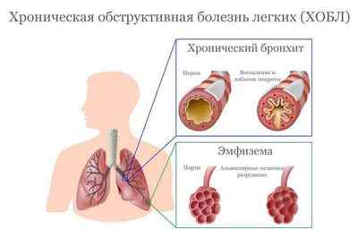 Інфекційна пневмонія: симптоми і лікування