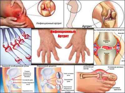 Інфекційний (септичний) артрит: симптоми і лікування