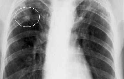 Інфільтрація легеневої тканини: що це таке, типи інфільтратів