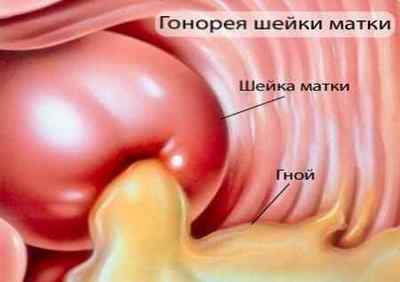 Інкубаційний період і перші симптоми гонореї