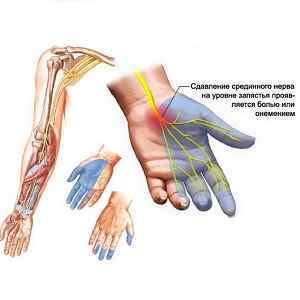 Німіють мізинці: причини і лікування оніміння пальця на лівій і правій руці, від чого вночі уві сні зводить безіменний на обох руках | Ревматолог