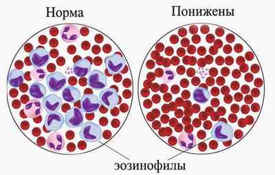 Норми і значення еозинофілів в крові