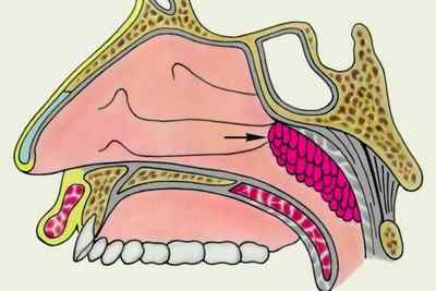 Носоглоткова мигдалина: анатомія, де розташована, гіперплазія глоткової мигдалини
