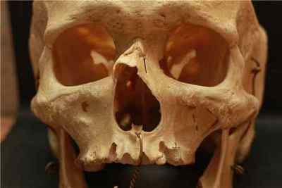Носова кістка - структура, розміри і причини болю