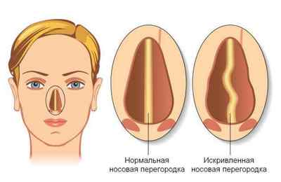 Носова перегородка: деформація, травми і їх лікування