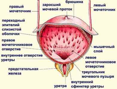 Інстиляція сечового міхура коларголом, протаргол і Димексиду