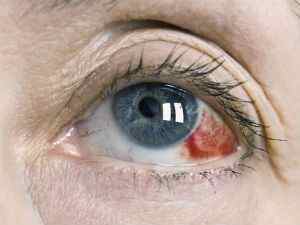 Інсульт очі: симптоми, лікування, як відновити зір