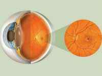 Інсульт очі: симптоми, лікування, як відновити зір