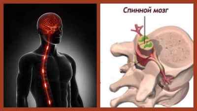 Інсульт спинного мозку: симптоми і лікування, причини, спинальний інсульт парез нижніх кінцівок | Ревматолог