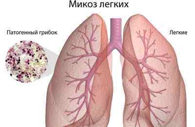 Інтерстиціальні захворювання легенів: класифікація, симптоми, лікування