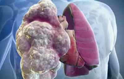 Інтерстиціальні захворювання легенів: класифікація, симптоми, лікування