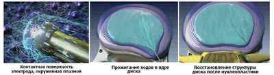 Нуклеопластіка міжхребцевого диска: холодноплазменная, лазерна