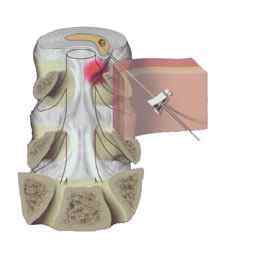 Нуклеопластіка міжхребцевого диска: холодноплазменная, лазерна
