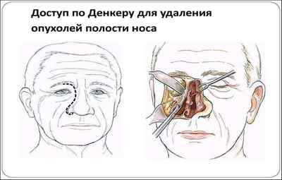 Інвертована папілома порожнини носа: симптоми і види операцій