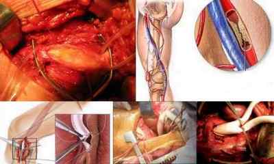 Облітеруючий атеросклероз судин нижніх кінцівок: причини, симптоми, лікування