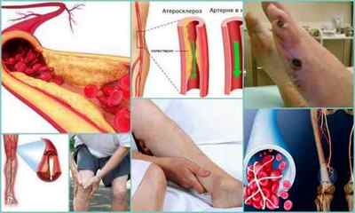 Облітеруючий атеросклероз судин нижніх кінцівок: причини, симптоми, лікування