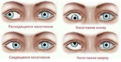 Очі в різні боки: різновиди косоокості, симптоми