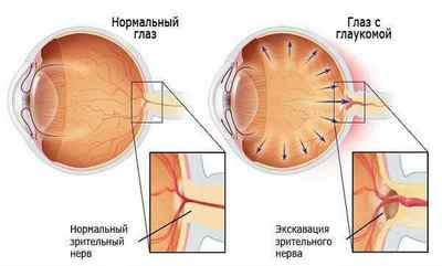 Очні хвороби у людини: список захворювань очей, назви, симптоми, лікування народними засобами