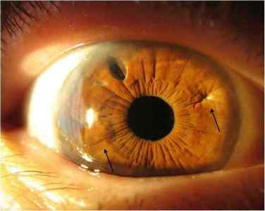 Очні хвороби у людини: список захворювань очей, назви, симптоми, лікування народними засобами