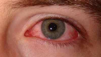 Очні краплі Деринат: інструкція із застосування, чи можна капати очі при конюнктивіті