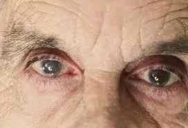 Очні краплі Каталін: інструкція із застосування для лікування очей, відгуки
