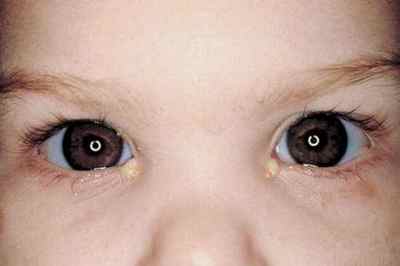 Очні краплі Левоміцетин для дітей: інструкція із застосування для новонароджених, відгуки