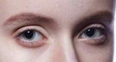 Очні краплі Мідрімакс: відгуки, інструкція із застосування крапель для очей
