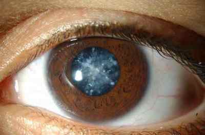 Очні краплі при цукровому діабеті 2 типу (для закапування очного дна діабетикам)