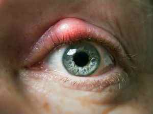 Очні краплі від халязиона у дорослого: лікування, ефективні препарати