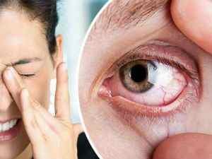 Очні краплі від конюнктивіту: лікування очей у дорослих, які ліки краще