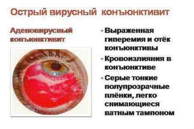 Очні інфекції: симптоми і лікування вірусних і інфекційних захворювань очей у людини
