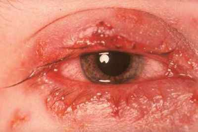 Очні інфекції: симптоми і лікування вірусних і інфекційних захворювань очей у людини