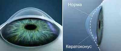 Очний гель Корнерегель: інструкція із застосування крапель для очей, відгуки, аналоги дешевше