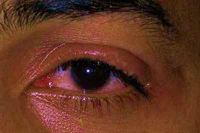 Офтальмоміаз очей: збудник у людини, як впроваджується внутрішньоочної паразит