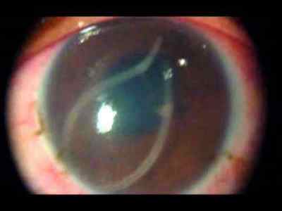 Офтальмоміаз очей: збудник у людини, як впроваджується внутрішньоочної паразит