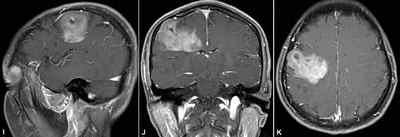 Олігодендрогліома головного мозку, лікування та прогноз на одужання