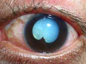 Онхоцеркоз (річкова сліпота) у людини: причини, симптоми, лікування