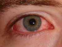 Онхоцеркоз (річкова сліпота) у людини: причини, симптоми, лікування