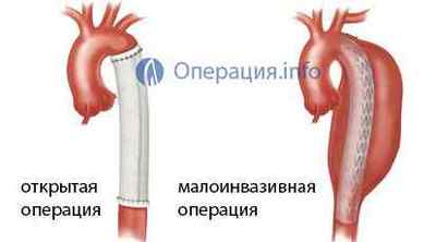 Операція на аневризму аорти: черевної порожнини, грудної