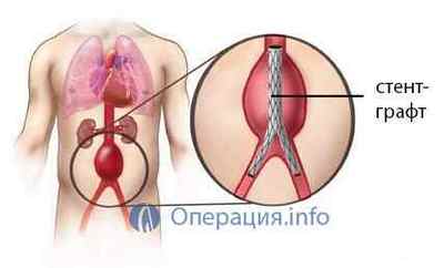 Операція на аневризму аорти: черевної порожнини, грудної