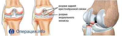 Операція на колінні звязки, хрестоподібні, при розриві