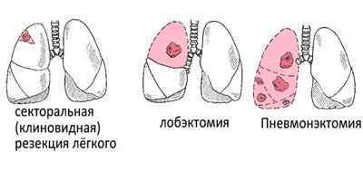 Операція на легенях при туберкульозі - хірургічне лікування