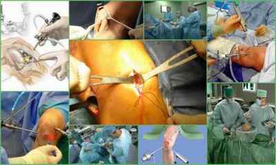 Операція на меніску колінного суглоба: проведення, реабілітація, ціна, відгуки