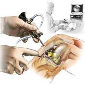 Операція на меніску: видалення, заміна і артроскопічна резекція, меніскектомія, наслідки та відновлення після | Ревматолог