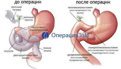 Операція на підшлункову залозу: видалення, резекція