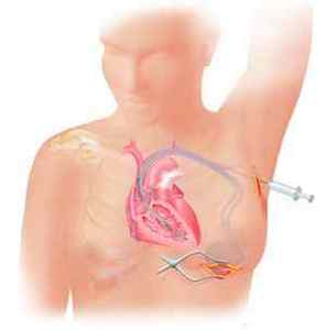 Операція по установці кардіостимулятора, показання, проведення