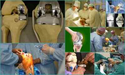 Операція по заміні колінного суглоба: як проходить, види, ціна, відгуки пацієнтів