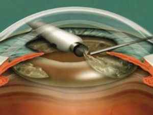 Операція по заміні кришталика ока: відгуки, як роблять, скільки триває, відновлення зору
